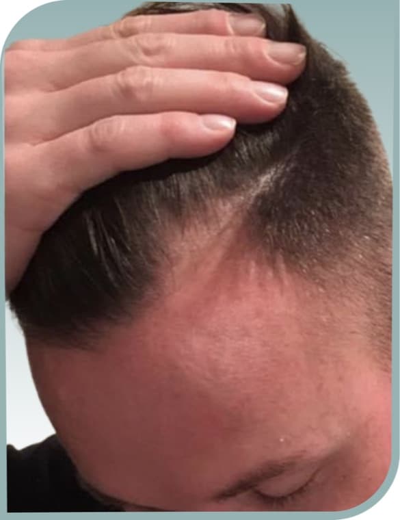 Receding frontal hairline, After photo (result 4 of 10)