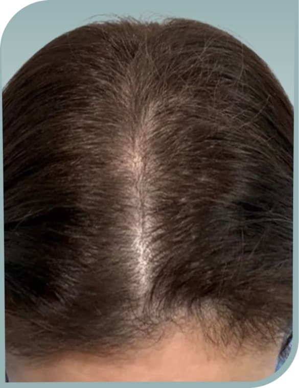 Widening crown part, After photo (result 5 of 10)