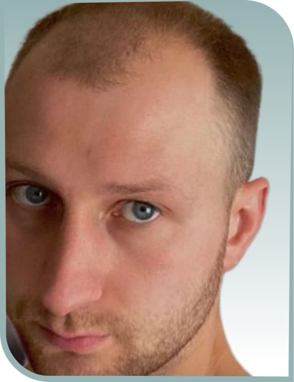 Receded front hairline, Before photo (result 6 of 10)