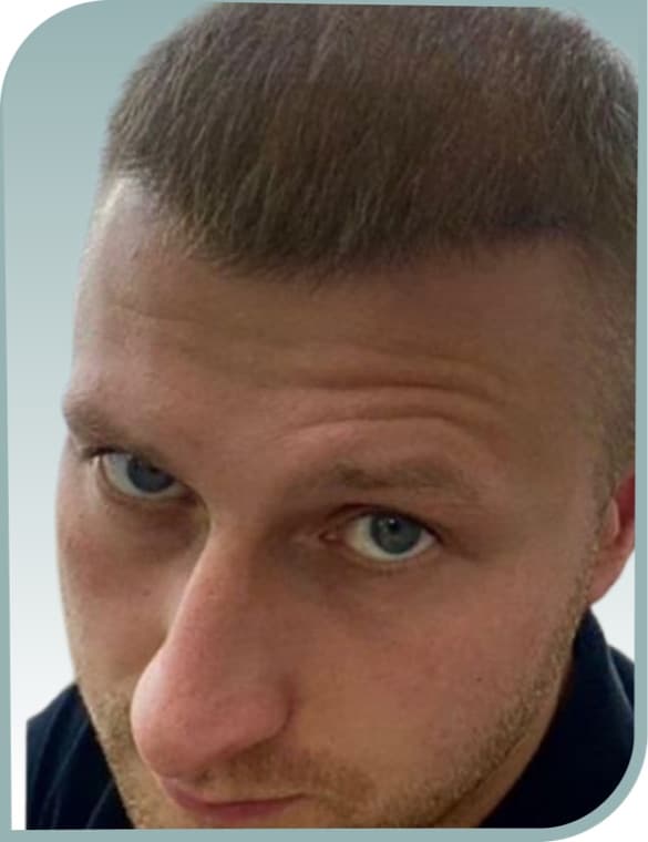 Receded front hairline, After photo (result 6 of 10)