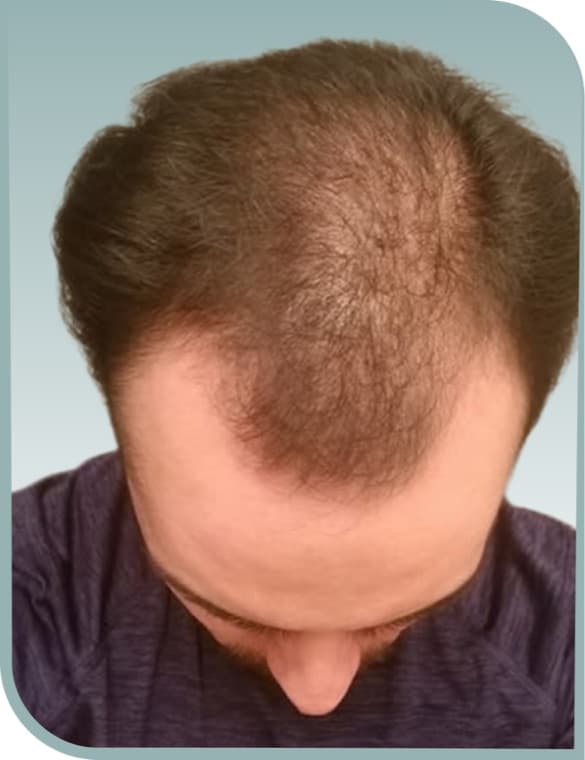 Top and vertex thinning, Before photo (result 7 of 10)