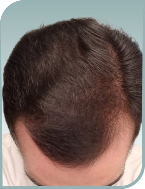 Top and vertex thinning, After photo (result 7 of 10)