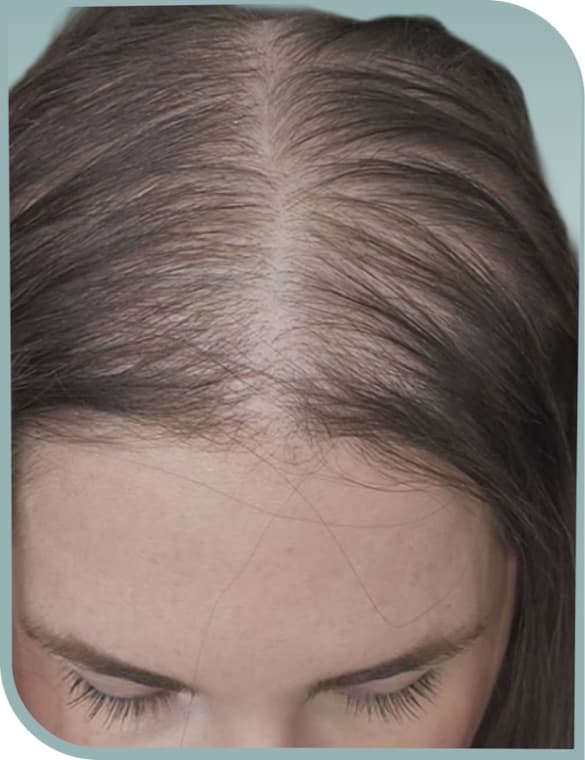 Thinning central parting, Before photo (result 8 of 10)