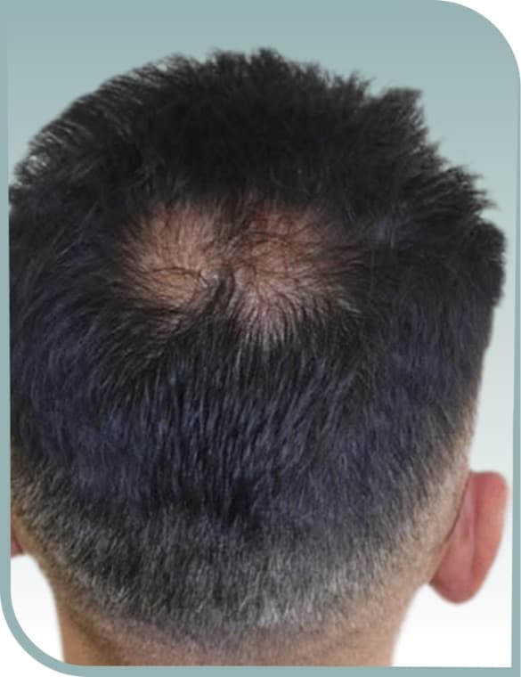 Crown bald patch, Before photo (result 9 of 10)