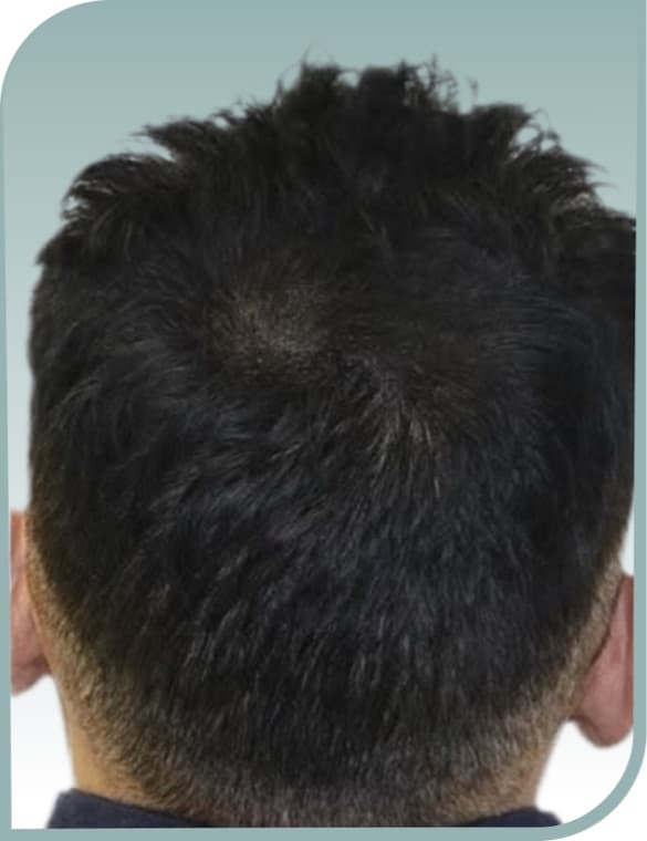 Crown bald patch, After photo (result 9 of 10)