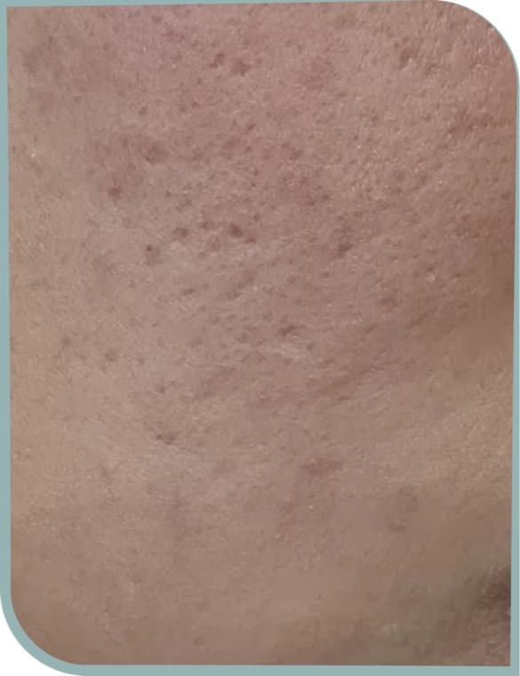 Smoother cheek texture, Before photo (result 2 of 10)