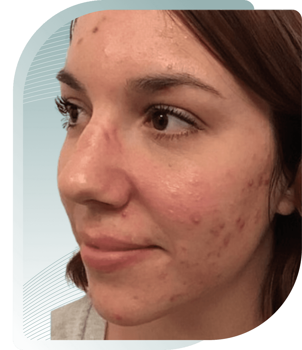 THE SECRET TO VISIBLY MORE BEAUTIFUL SKIN – OUR CUSTOMERS SHOW YOU HOW. — Before photo (result 1 of 4)