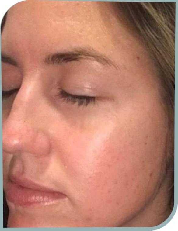 Settled, clearer skin, Before photo (result 6 of 10)