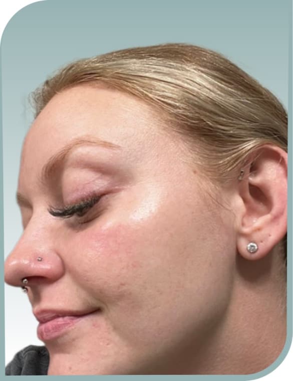 Settled, clearer skin, After photo (result 6 of 10)