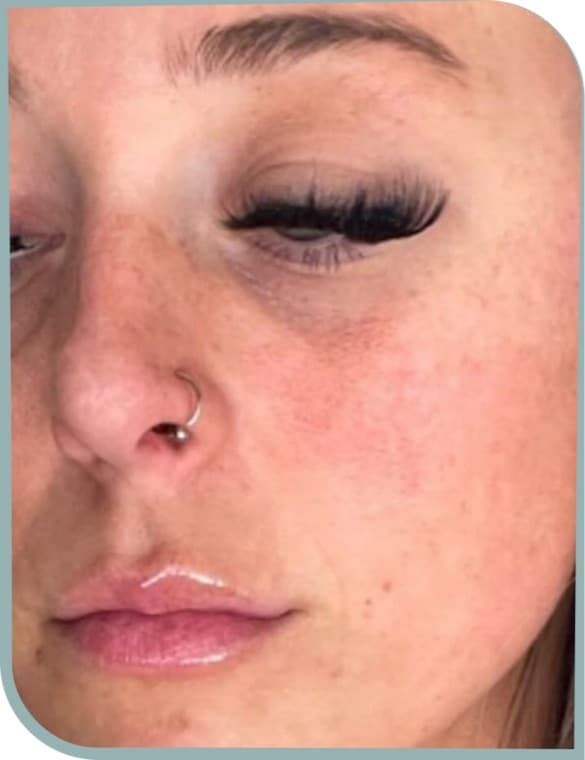 Under eye brightening, Before photo (result 8 of 10)