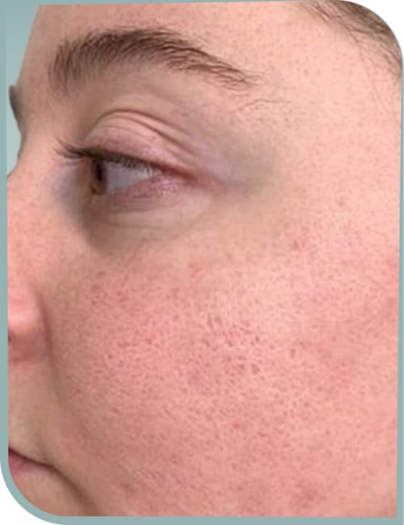 Refined pores, Before photo (result 5 of 10)