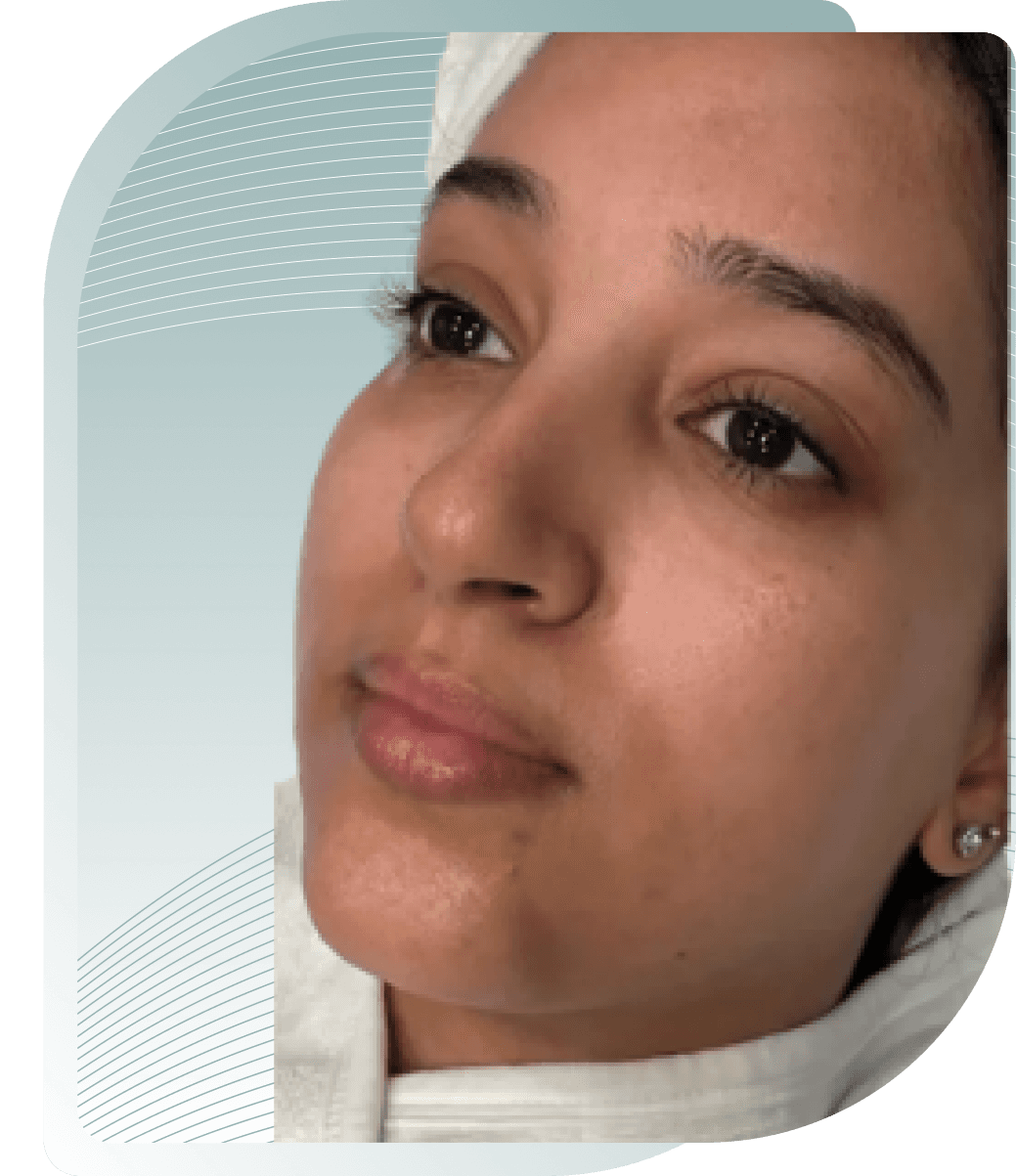 THE SECRET TO VISIBLY MORE BEAUTIFUL SKIN – OUR CUSTOMERS SHOW YOU HOW. — Before photo (result 4 of 4)