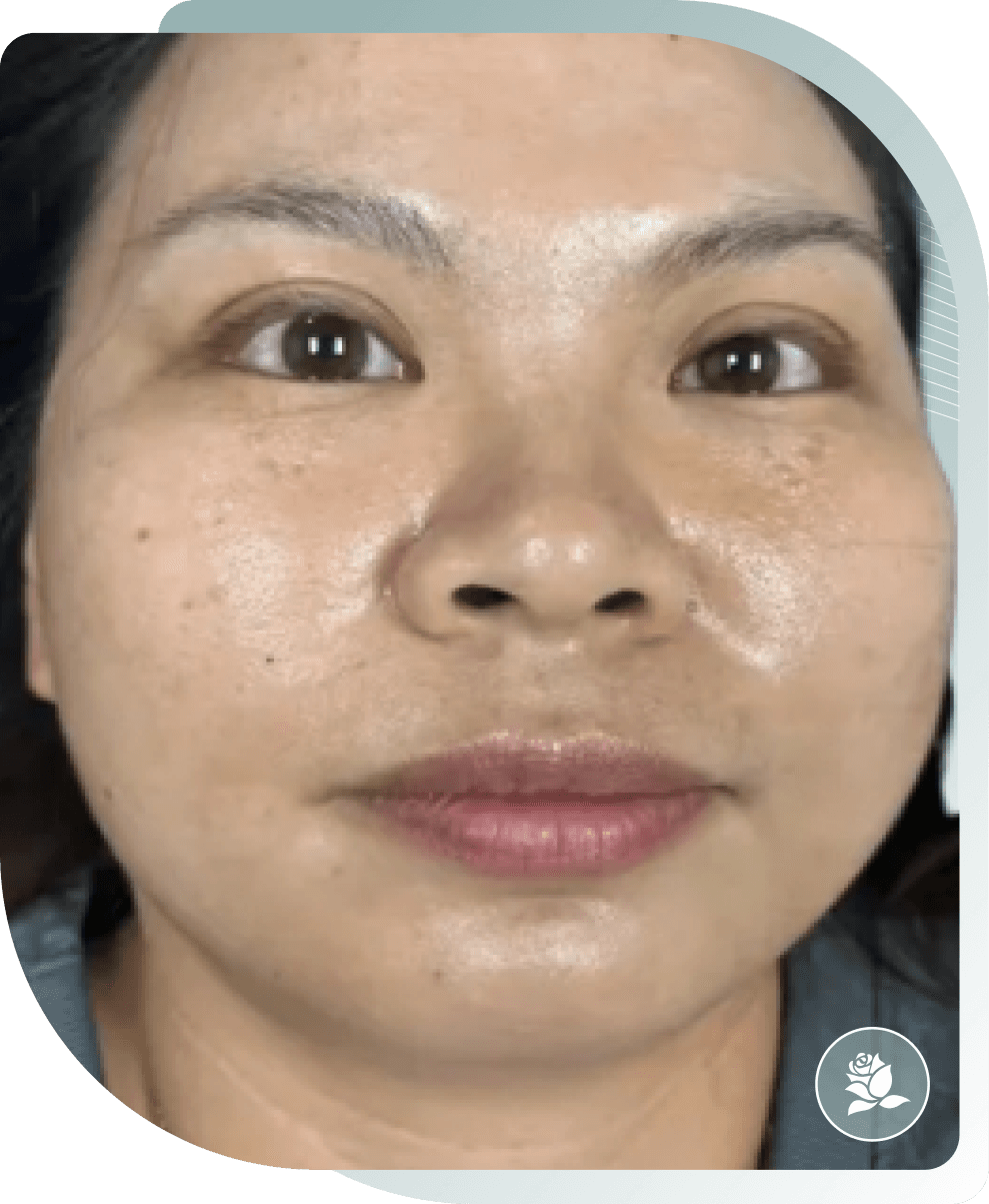 Pigmentation — After photo (result 5 of 5)