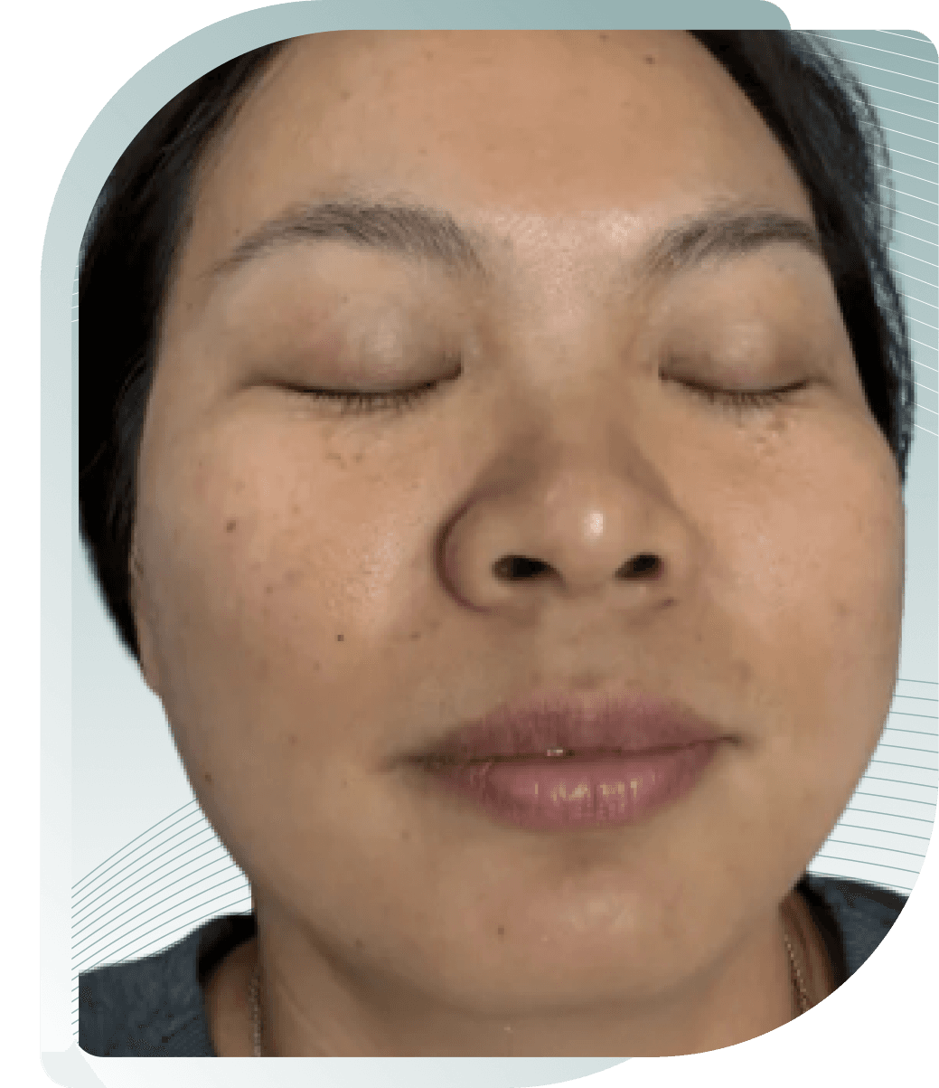 Pigmentation — Before photo (result 5 of 5)