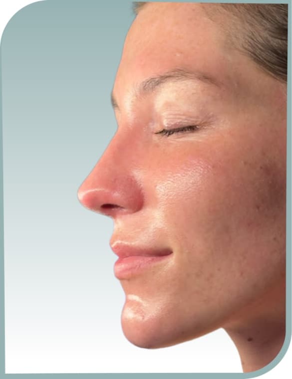 Hydration and even tone, After photo (result 4 of 10)