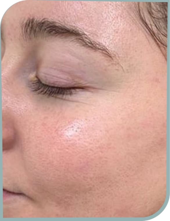 Refined pores, After photo (result 5 of 10)