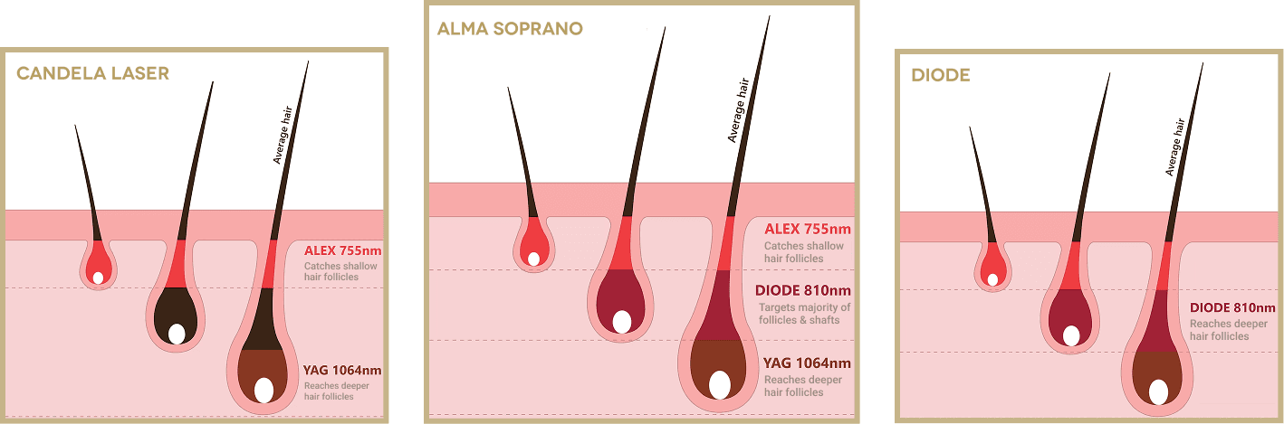 Alma Soprano's triple-wavelength technology targets every depth of follicle — for the first time in Malta.