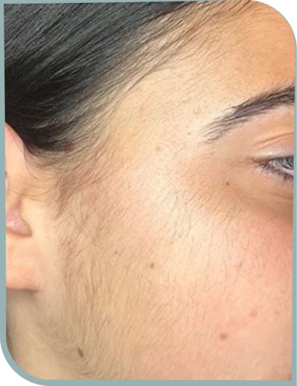 Facial cheek hair, Before photo (result 5 of 10)