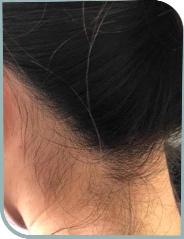 Nape hairline, Before photo (result 8 of 10)