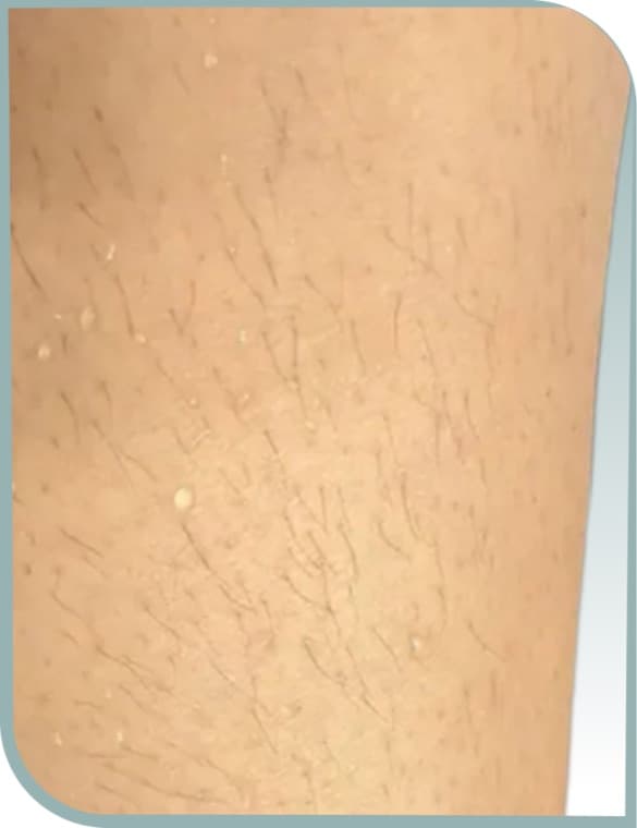 Thigh hair, Before photo (result 2 of 10)