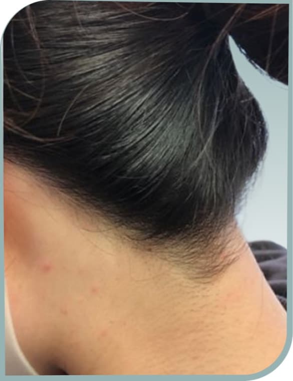 Nape hairline, After photo (result 8 of 10)