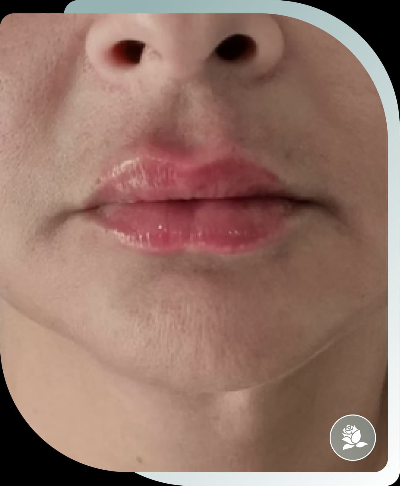 After photo: Lip Fillers result at Carisma Aesthetics Malta
