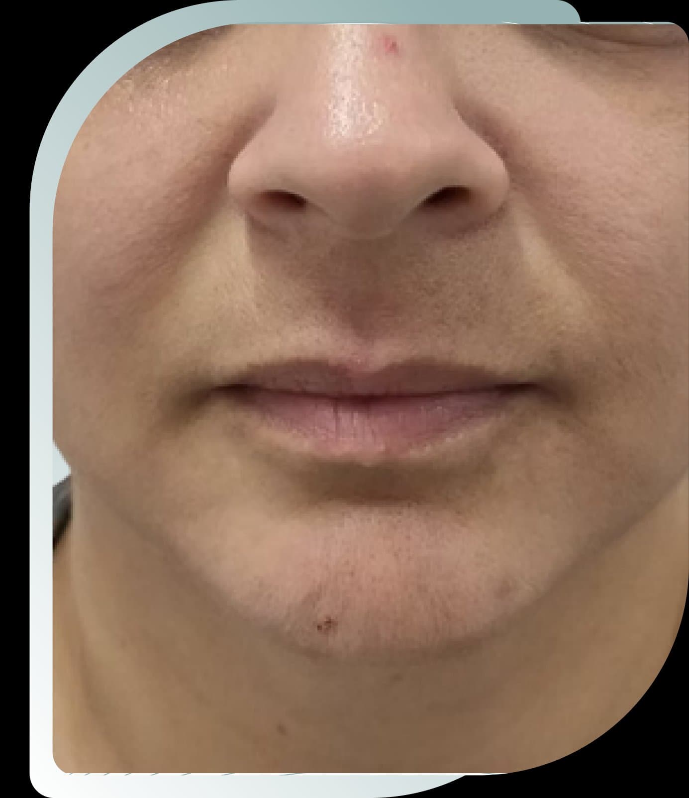 Before photo: Lip Fillers result at Carisma Aesthetics Malta