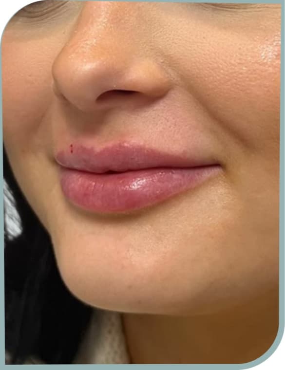 Lip augmentation, After photo (result 9 of 10)