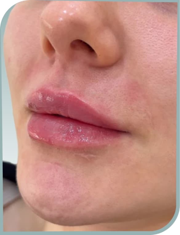 Fuller lip shape, After photo (result 10 of 10)