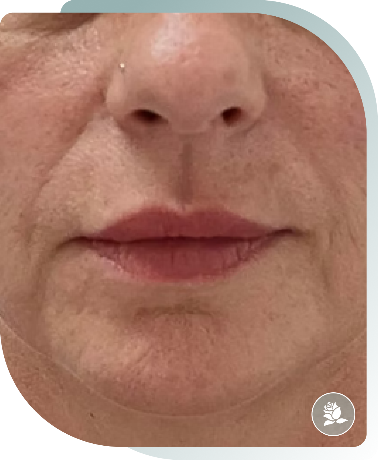 Hydration & Definition — After photo (result 2 of 5)