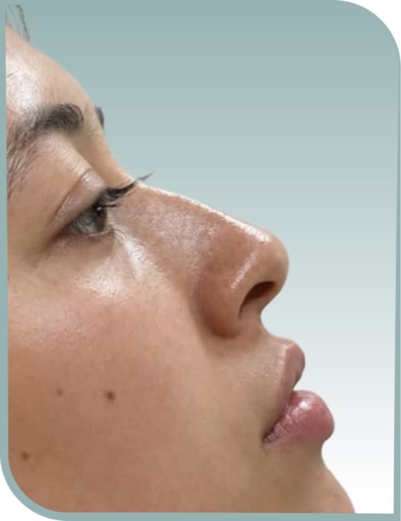 Balanced lip volume, Before photo (result 5 of 10)