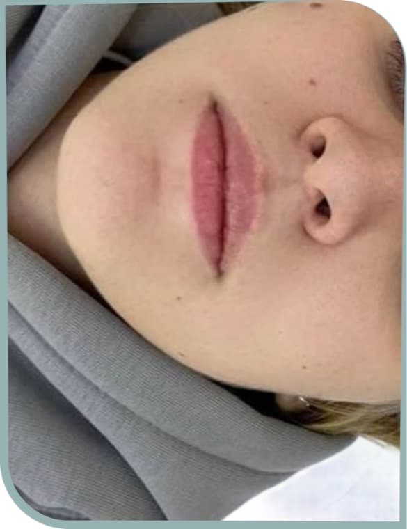 Defined lip border, Before photo (result 6 of 10)
