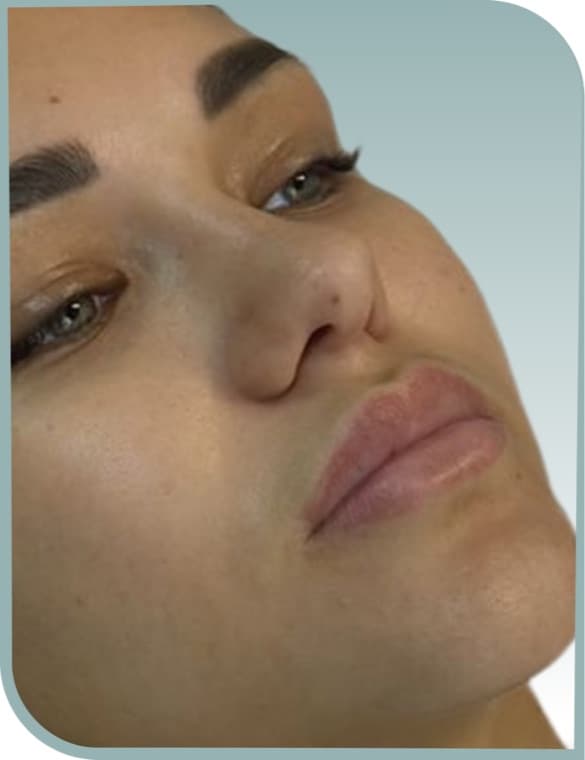 Even lip volume, Before photo (result 8 of 10)