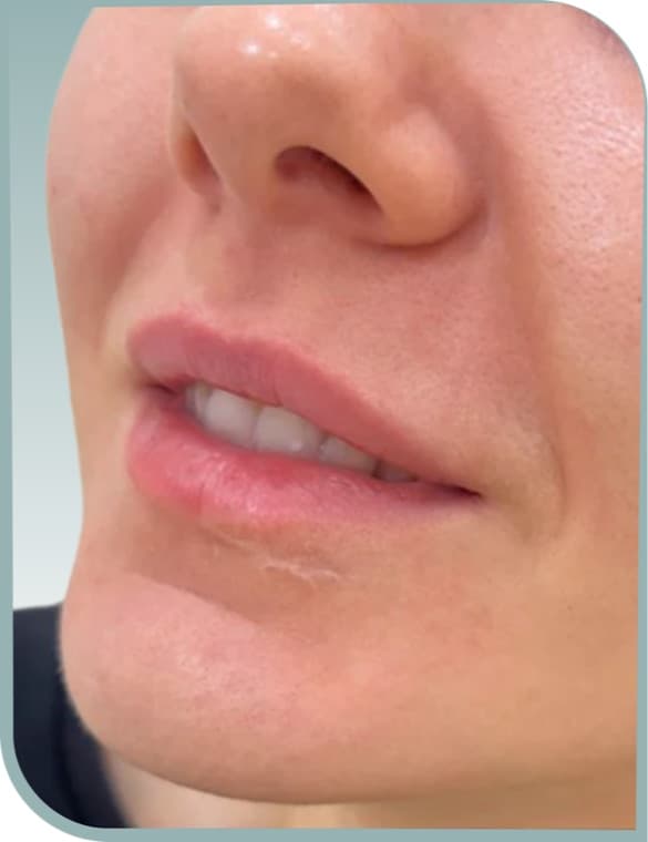 Fuller lip shape, Before photo (result 10 of 10)