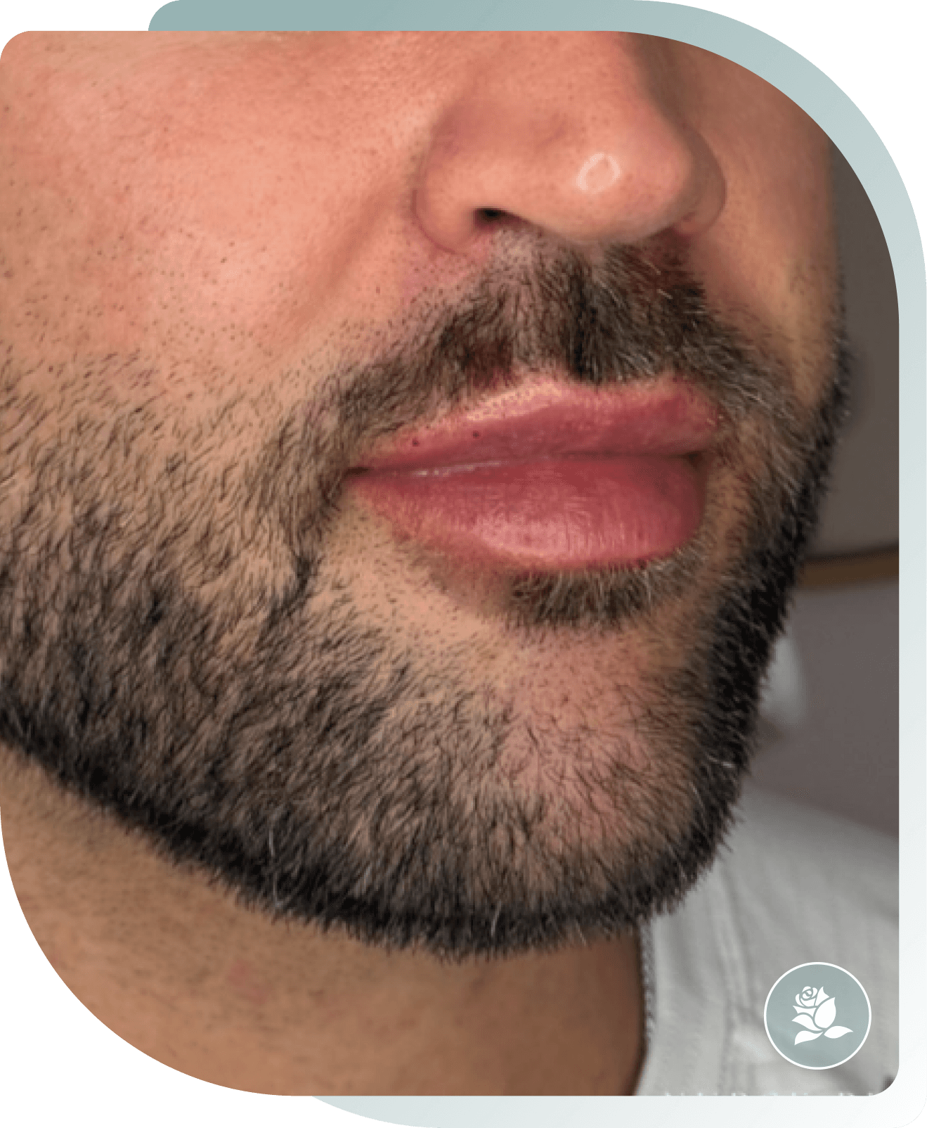 Subtle Enhancement — After photo (result 5 of 5)