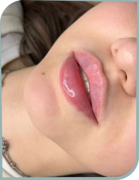 Lip shaping, After photo (result 4 of 10)