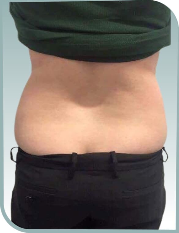 Lower back slimming, Before photo (result 1 of 10)