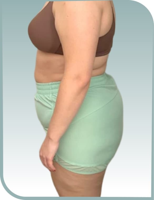 Waist and hip slimming, Before photo (result 2 of 10)
