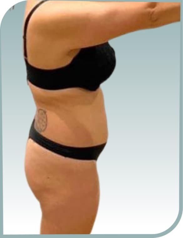 Midsection slimming, After photo (result 9 of 10)