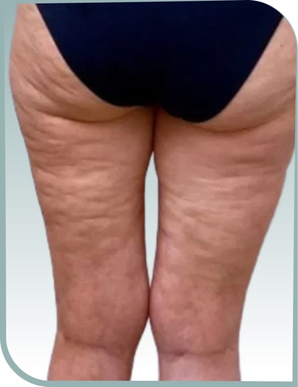 Back thigh smoothing, Before photo (result 3 of 10)
