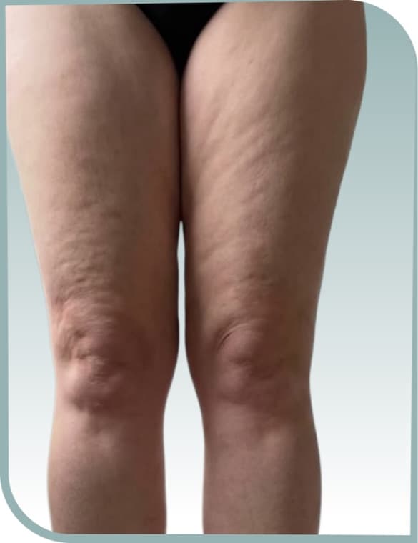 Front thigh smoothing, Before photo (result 5 of 10)