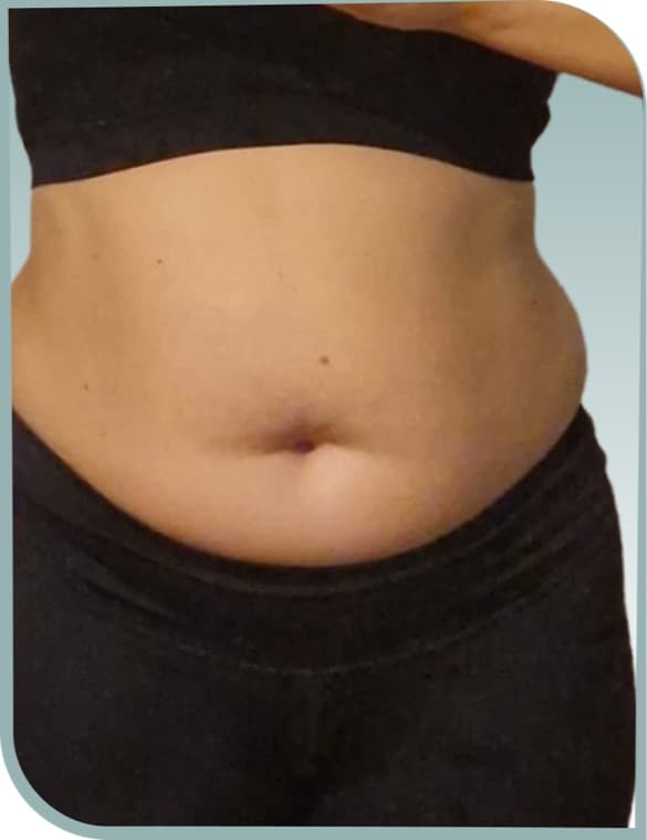 Tummy slimming, Before photo (result 7 of 10)