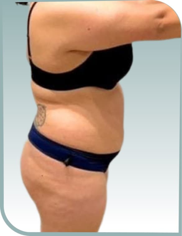 Midsection slimming, Before photo (result 9 of 10)