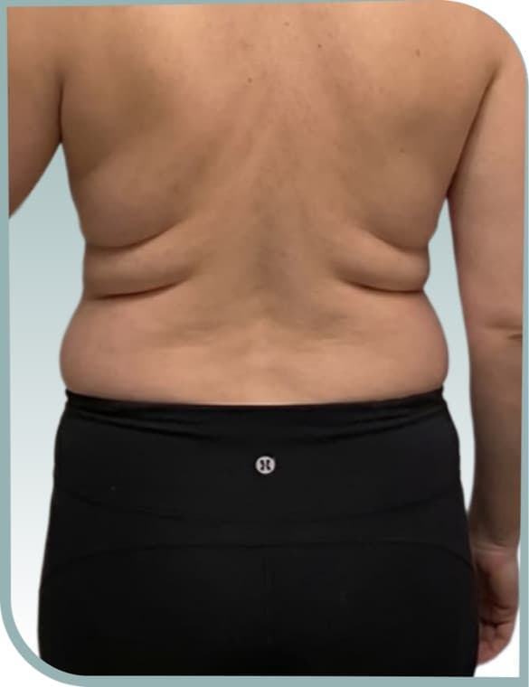 Back and bra-line slimming, Before photo (result 10 of 10)