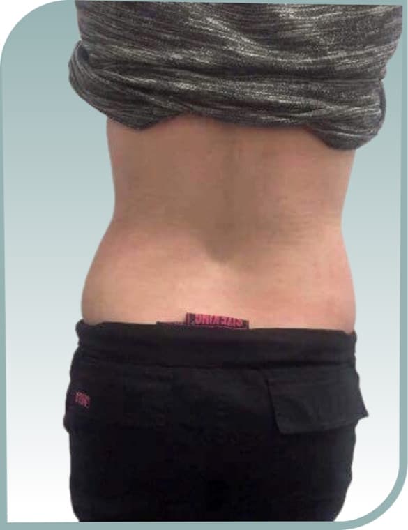 Lower back slimming, After photo (result 1 of 10)