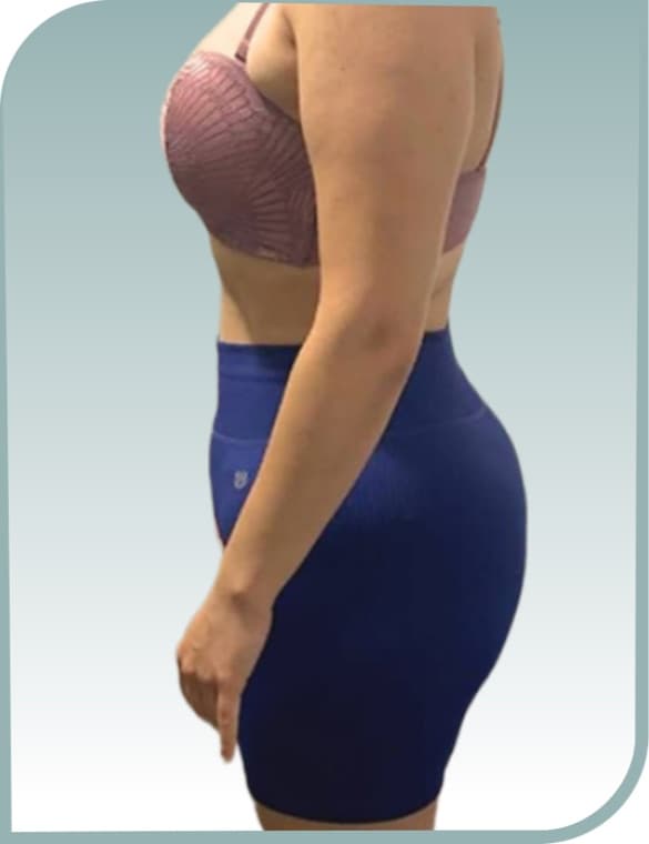 Waist and hip slimming, After photo (result 2 of 10)