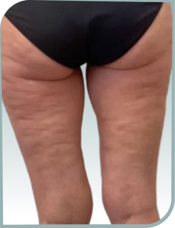 Back thigh smoothing, After photo (result 3 of 10)