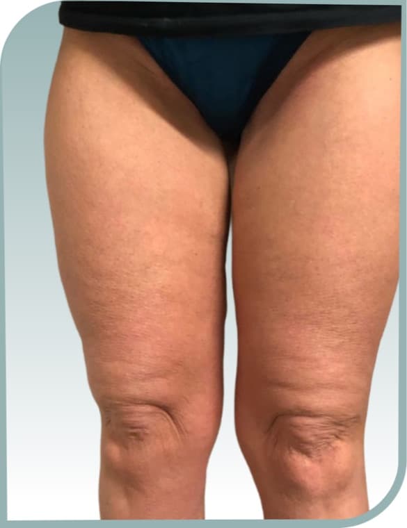Thigh and knee texture, After photo (result 4 of 10)
