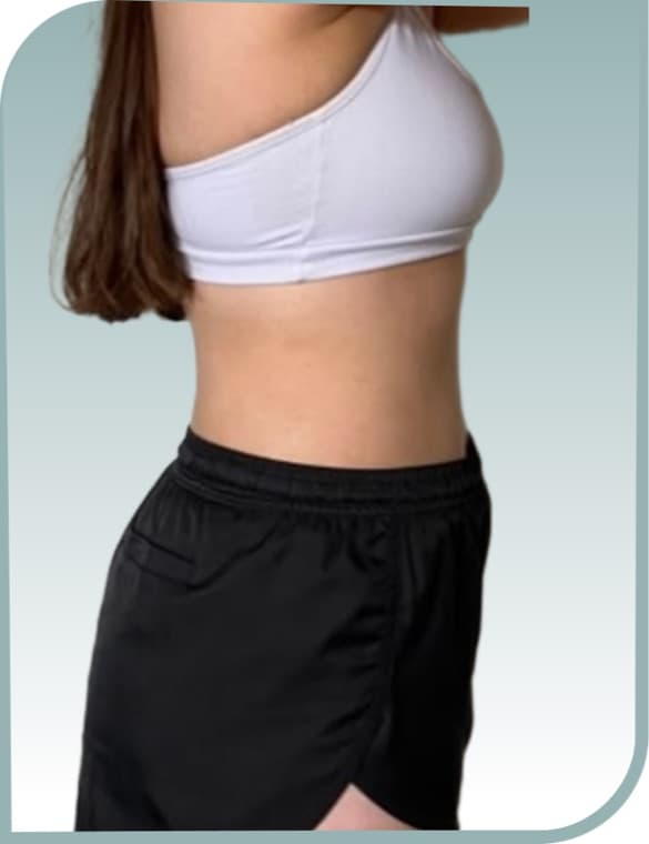 Lower tummy slimming, After photo (result 8 of 10)