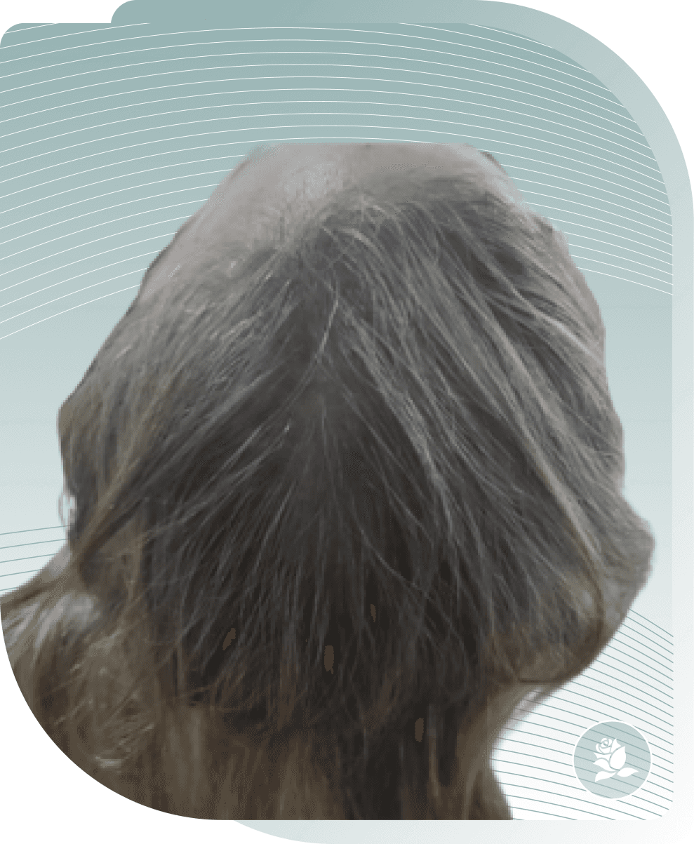 Diffuse Thinning (Female) — After photo (result 3 of 3)